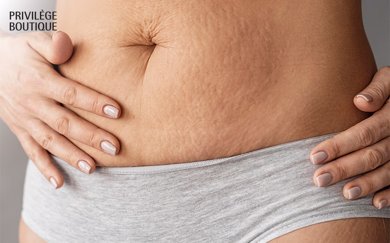 Close-up of lower abdomen with visible stretch marks and loose skin, hands resting on sides.