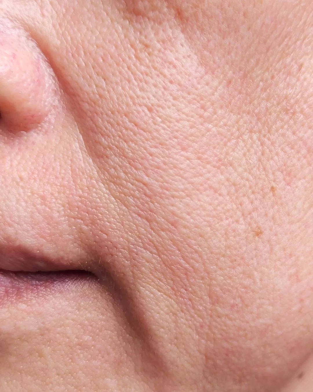 Close-up of face with acne scars