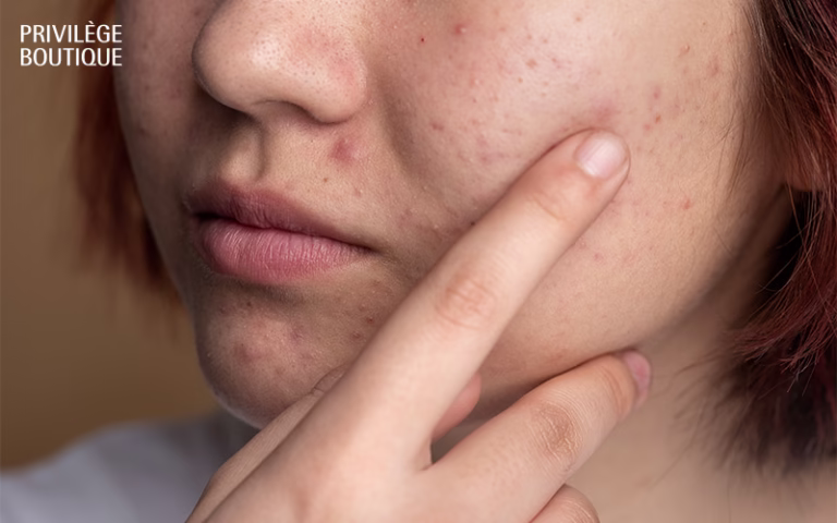 Close-up of a person's face pointing out acne on their cheek.