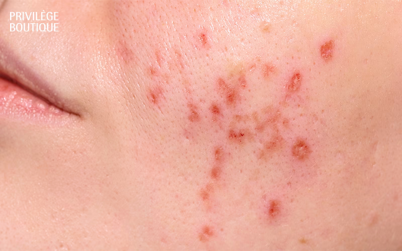 Close-up of facial acne for Traditional Chinese Medicine skin analysis.