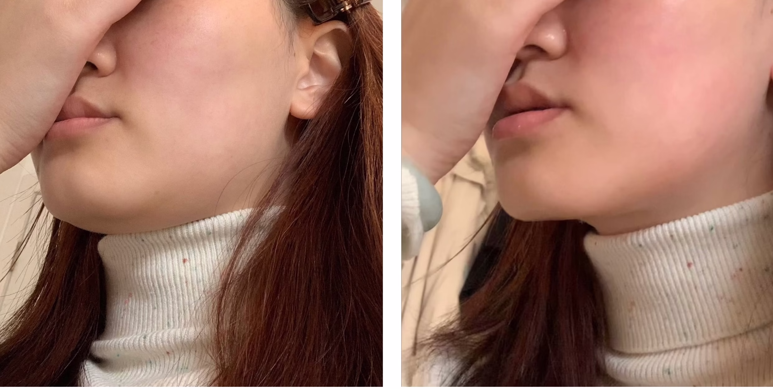 Acne Before After