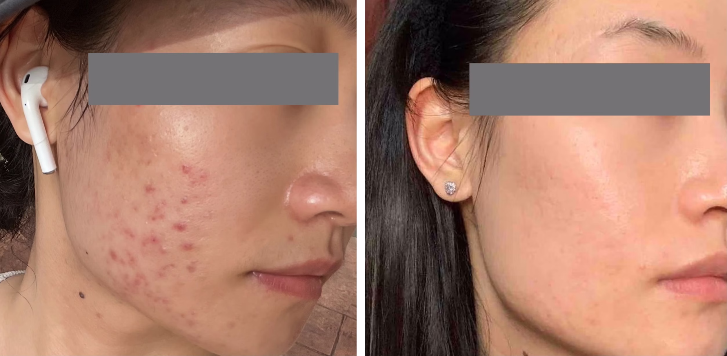 Before After